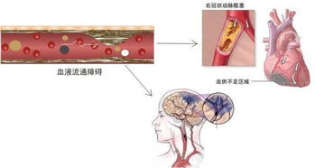 心脑血管 食疗